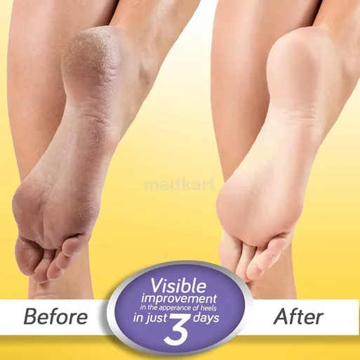krack heel repair cream 25 gm